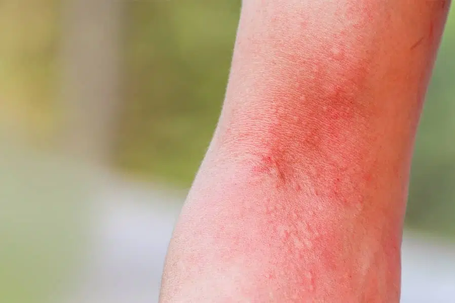 Insect bites can look like a rash on your skin. Always treat the bite right away. 