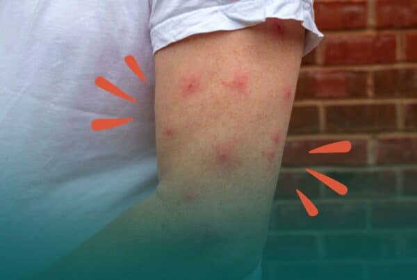A close-up of a person's upper arm showing multiple red, swollen bug bites with stylized orange accent marks on either side.