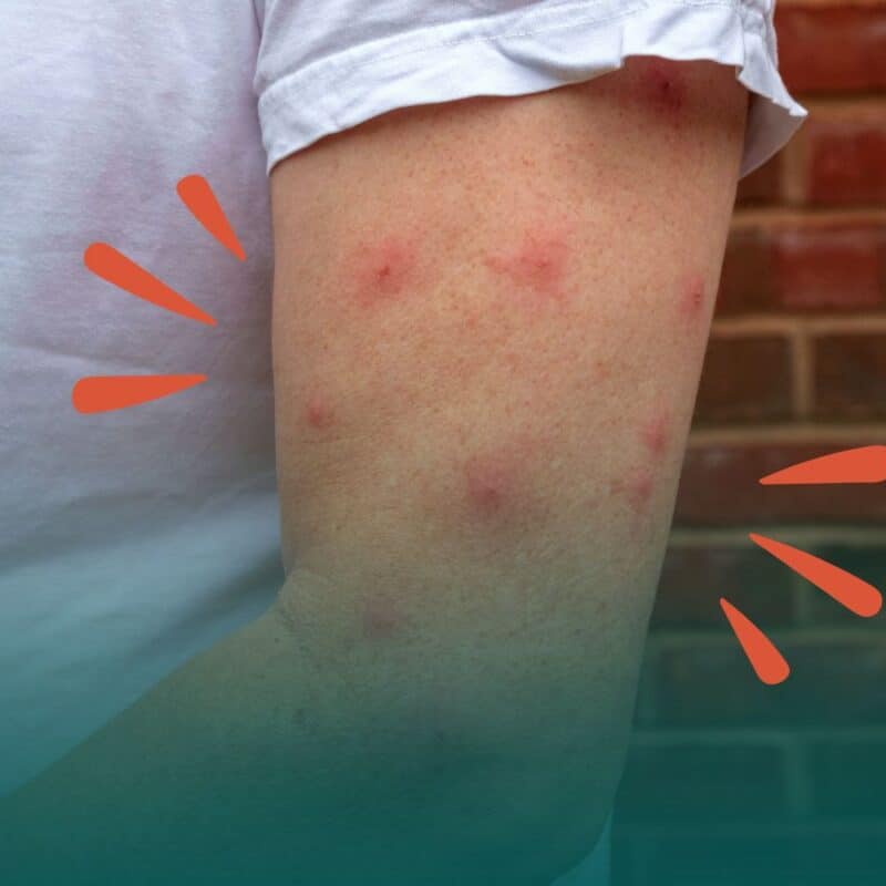 A close-up of a person's upper arm showing multiple red, swollen bug bites with stylized orange accent marks on either side.